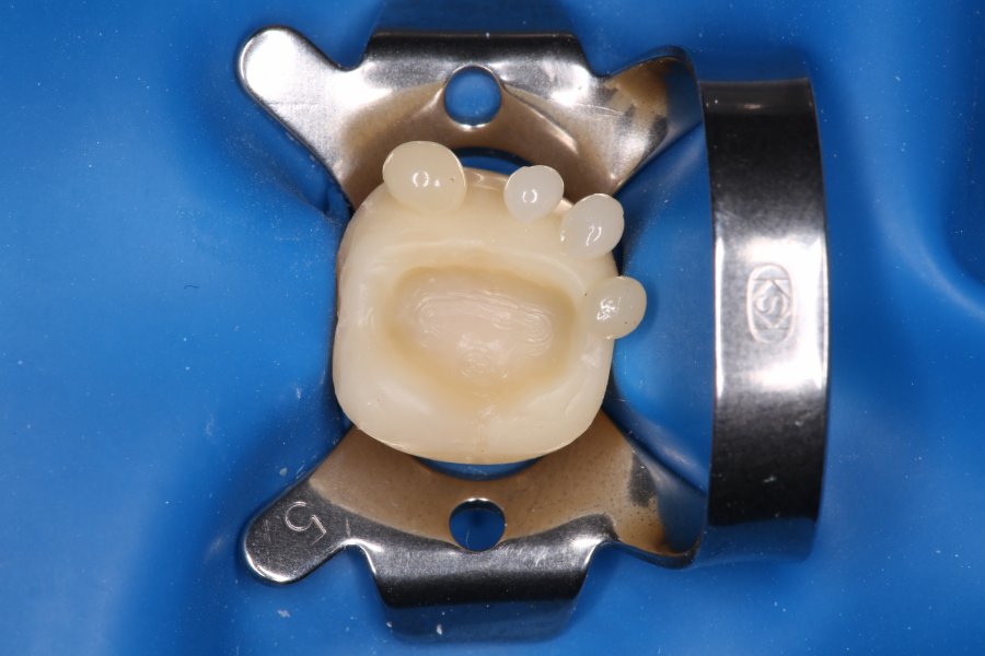 Diafil dental diadent