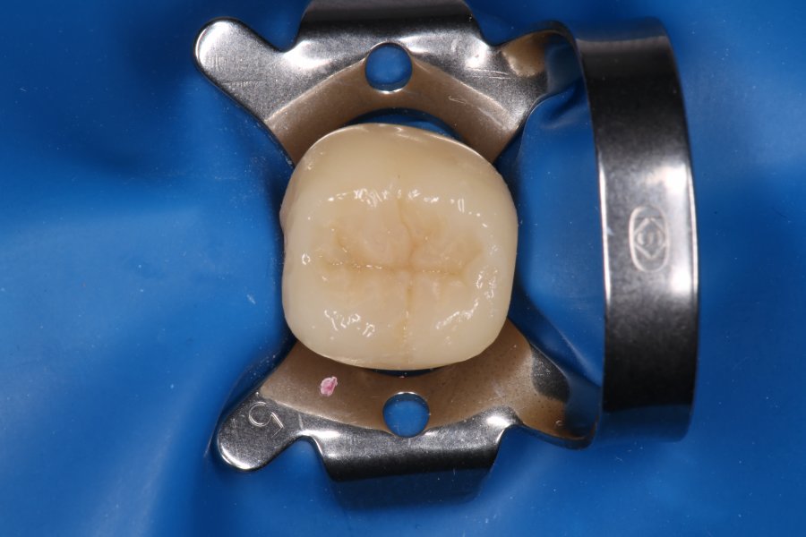 Diafil dental diadent
